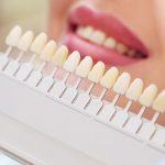 Get a sparkling smile with Teeth Whitening Process