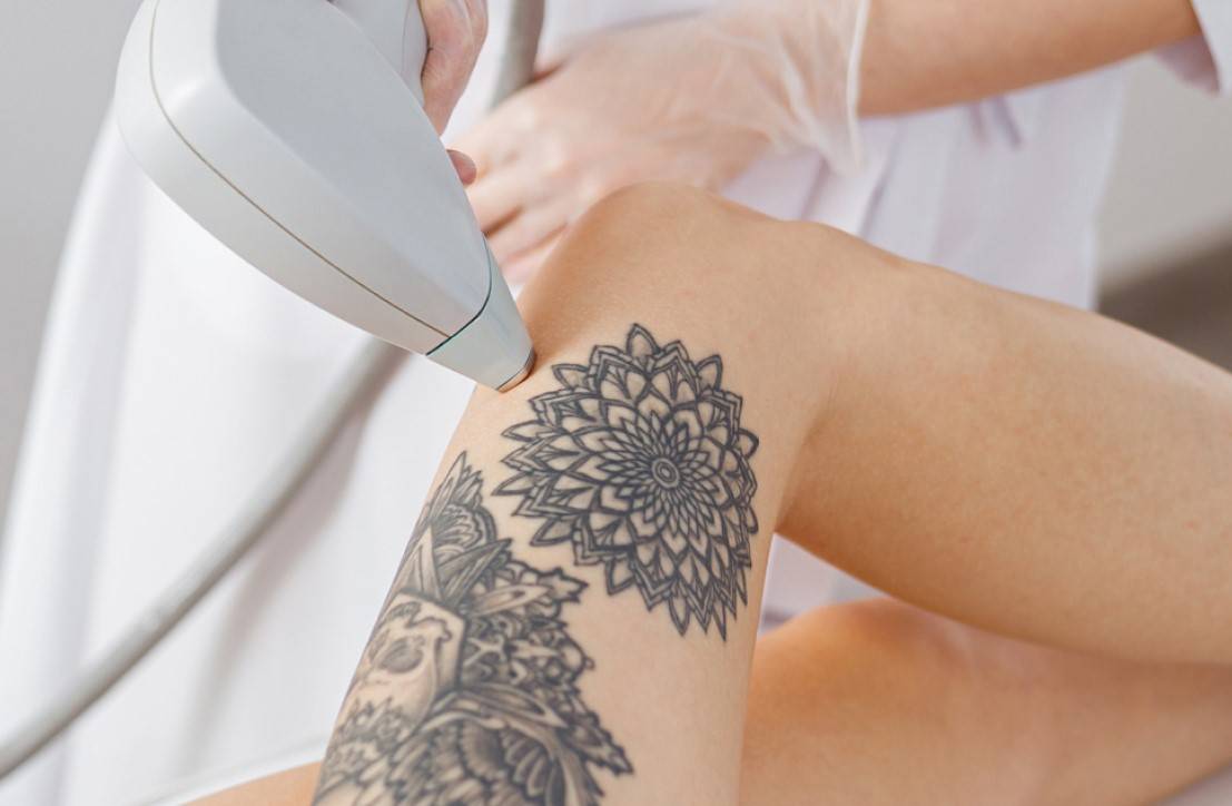 laser hair removal
