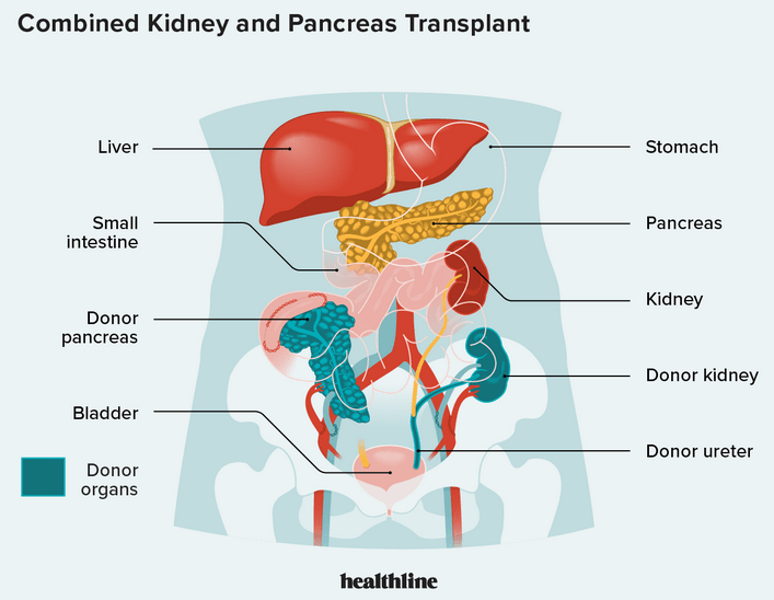 Kidney and pancreas transplantation