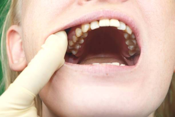 mouth cancer