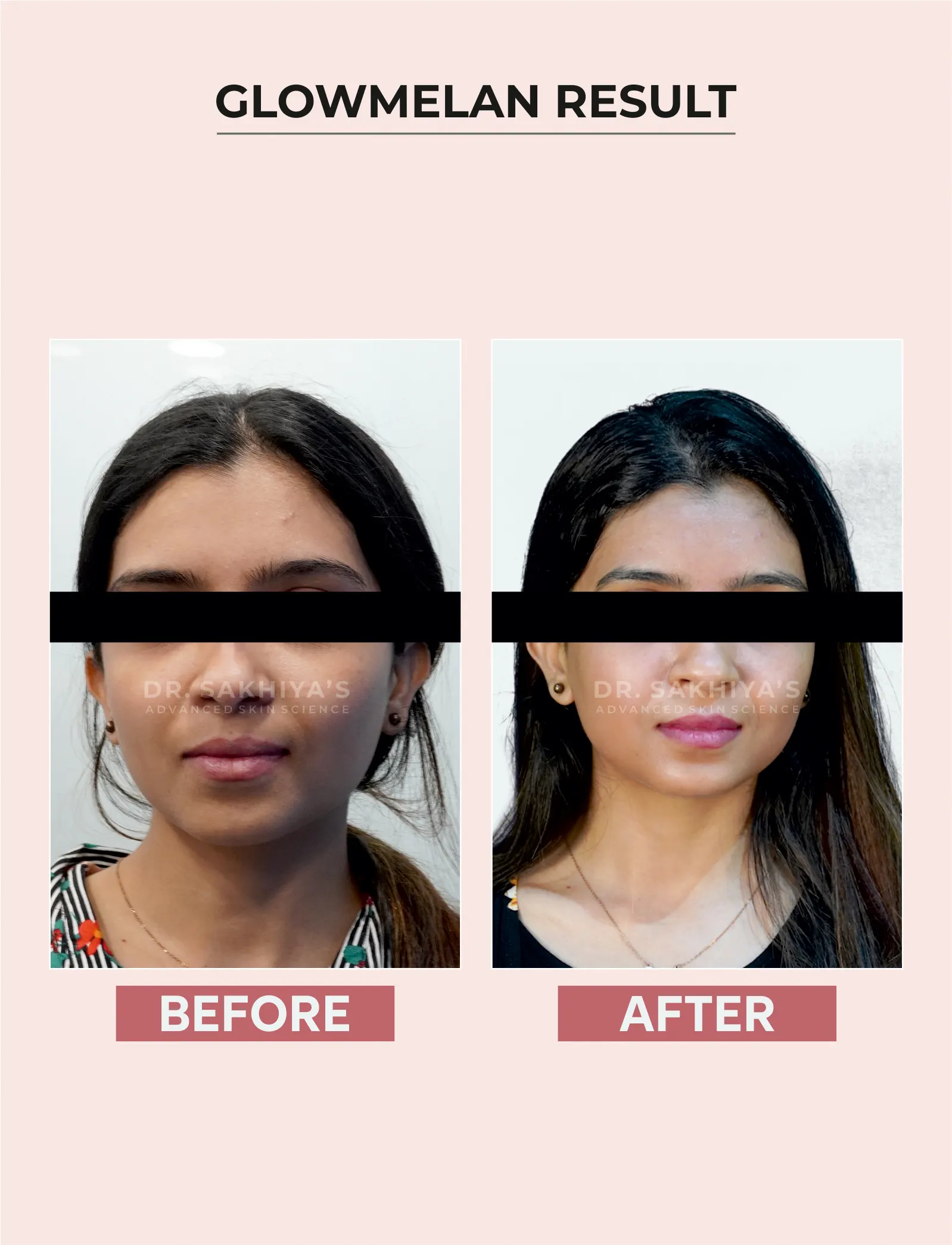 Glowmelan Face Whitening Cream for Women