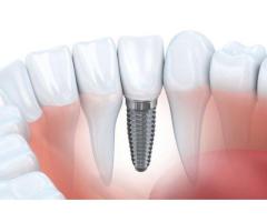 Dental Implant in Karaikudi