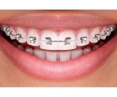 Teeth Alignment Braces In Karaikudi
