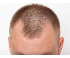 SMP by ROB | Hair Replacement Service in San Dimas CA