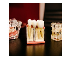 Implant Dentistry in The Colony