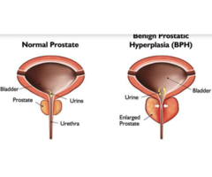Comprehensive Guide to Benign Prostate Hypertrophy Treatment