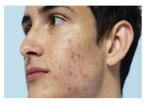 Conquer Acne Spots with Our Targeted Solution