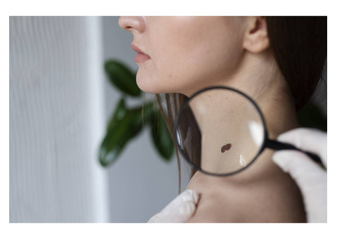 How to Remove Skin Tags Safely, According to Dermatologists