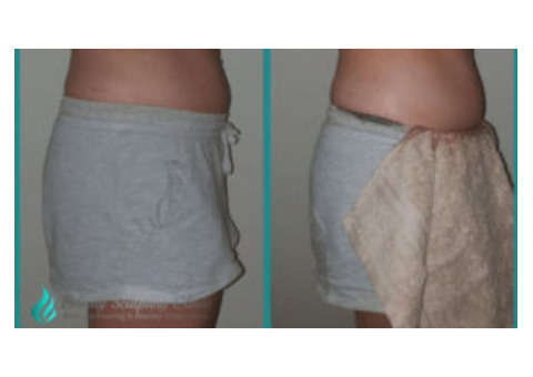 Instant Fat Reduction Result- Beauty Sculpting Clinic Pty Ltd