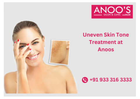 Uneven Skin Tone Treatment with Advanced methods at Anoos