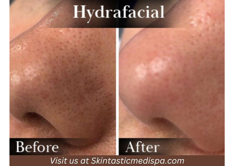 Prop Up Your Skin with Hydrafacial in Riverside