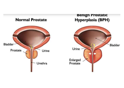Benign Prostate Hypertrophy Treatment
