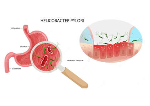 Helicobacter Pylori Treatment & Management