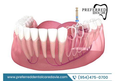 Get Trusty Solution for Your Search of Quality Root Canals Near Me