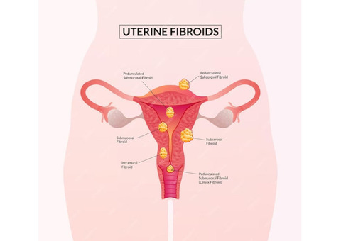 Get Consultation on Uterine Fibroid in Ahmedabad