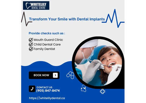 Dental Implant Service in Oakville, ON