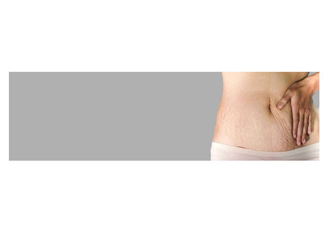 stretch marks treatment in Hyderabad