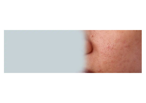 Open Pores Treatment in Greater Kailash