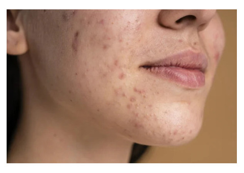 acne scar treatment in Hyderabad