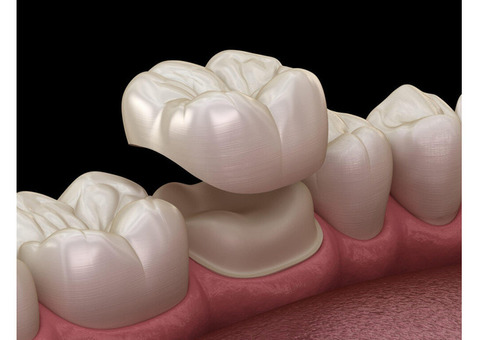 Drchemla Offers the Best Dental Bridge Services