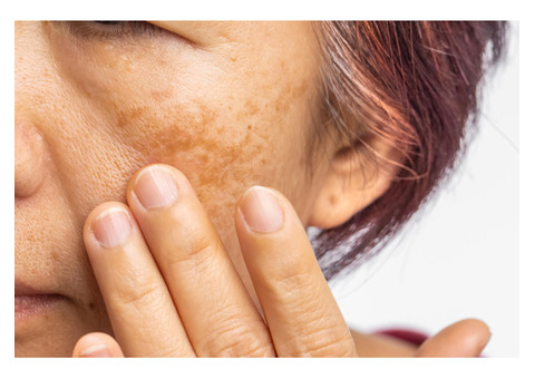 Illuminate Your Skin: Melasma Treatment in Delhi