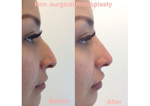 Non-Surgical Nose and Lips Augmentation in Richmond