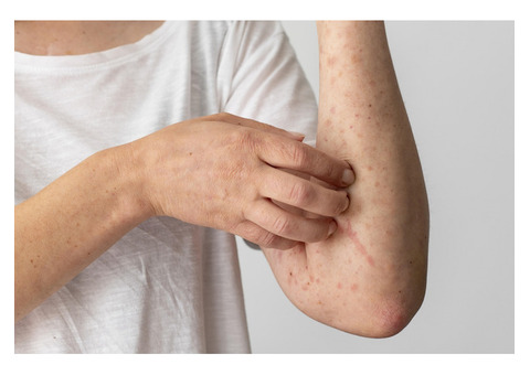 Decoding Eczema: Understanding the Root Causes