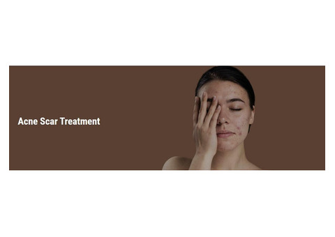 Acne scar treatment in south delhi