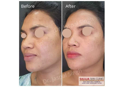 Skin treatment in Bilaspur | Saluja skin clinic