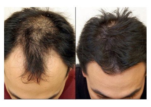 Eminence Look | Hair Replacement Service in Queens NY