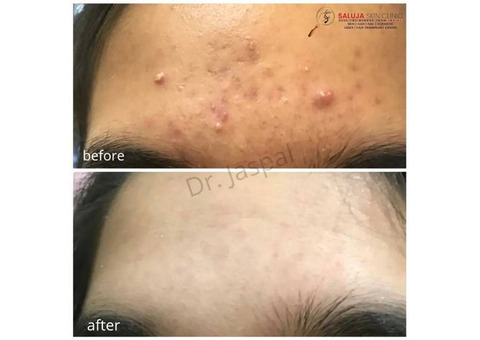 Best acne clinic in bilaspur | Saluja skin clinic