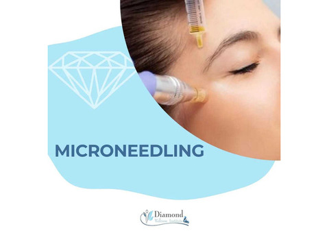 Microneedling for Acne: An Effective Treatment for Reducing Acne Scars