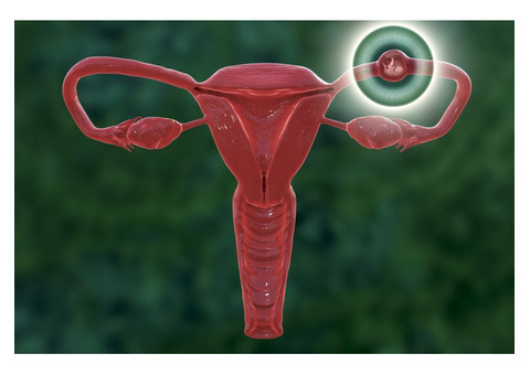 Ectopic Pregnancies and the Threat of State Abortion Bans