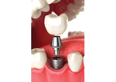 Best dental Implants clinic in Perris | Dentist in Perris | Nuevo