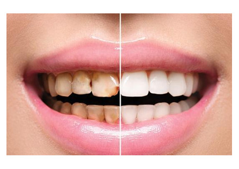 Full Mouth Rehabilitation| Aashu dental | 9825158578