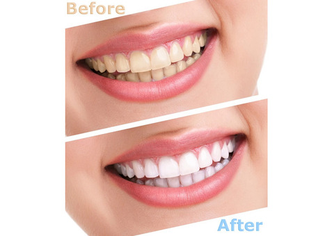 Dr. Chemla’s Dental Clinic Offers the Best Teeth Whitening Treatment