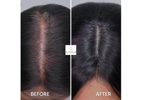 Hair Replacement System for Women