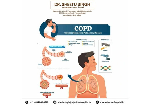 Best Doctor for COPD Treatment in India - Dr. Sheetu Singh