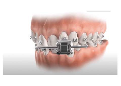 Braces Treatment Murrieta | Pesh Orthodontics