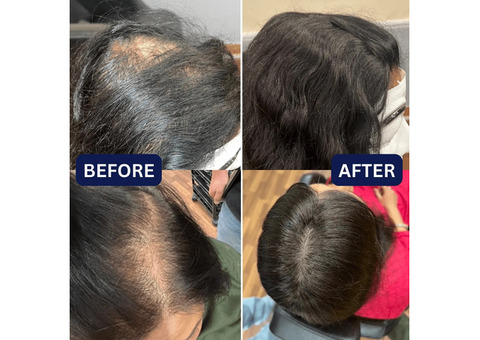 Best Hair System Service In Bangalore