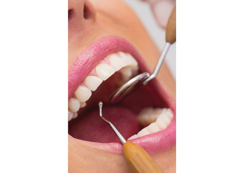 Get the best root canal Treatment | Nuevo Perris Dental