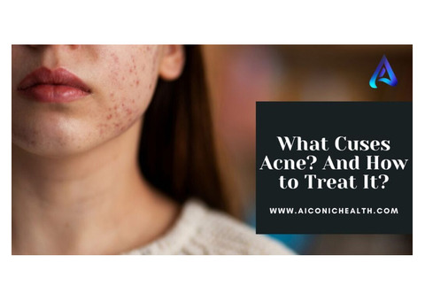 What Causes Acne And How to Treat It?