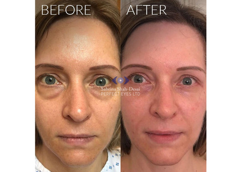 Eye Bag Removal in London, UK