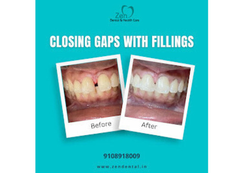 Best Dental Filling Treatment in Sarjapur Road, Bangalore