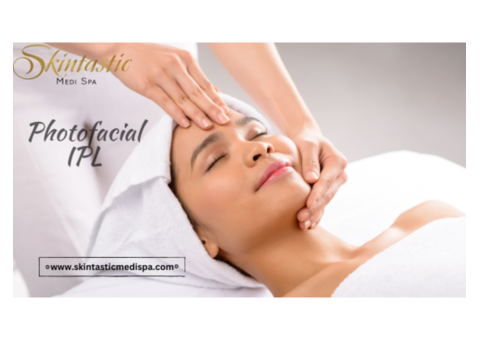 Top Notch Photofacial IPL in Riverside