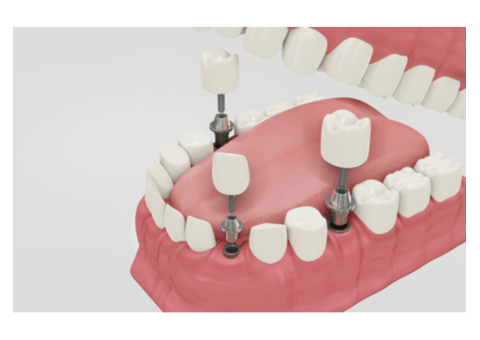 Get Dental implant clinic | Dr. Manish shah | 9825158578