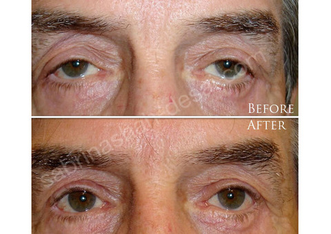 Ptosis Surgery in London, UK