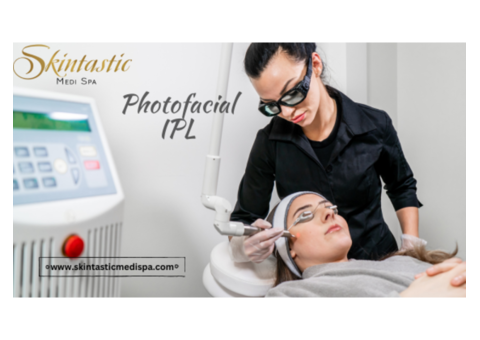 Best Photofacial IPL Treatment in Riverside