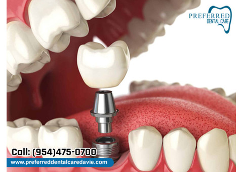 Top Implants Denture Service With The Best Care and Top Results