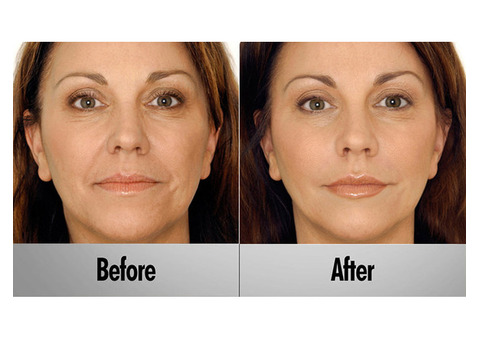 Vampire Facelift Treatment in Warrenton – Lifestyle's MedSpa